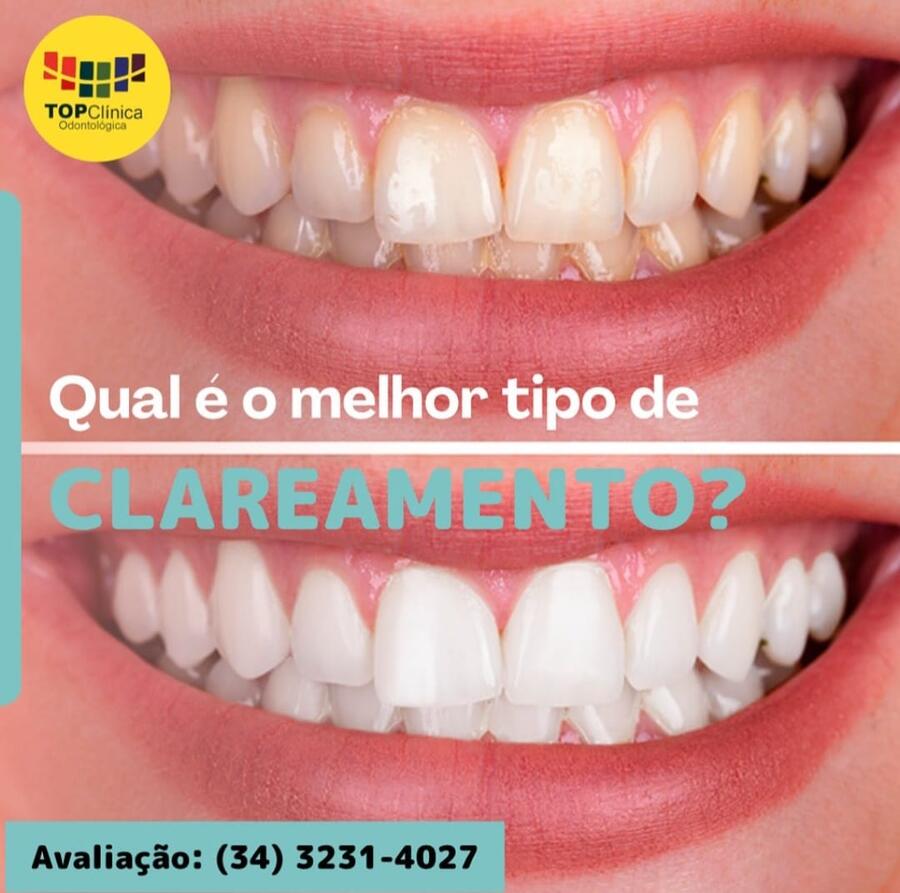 Qual o melhor tipo de clareamento