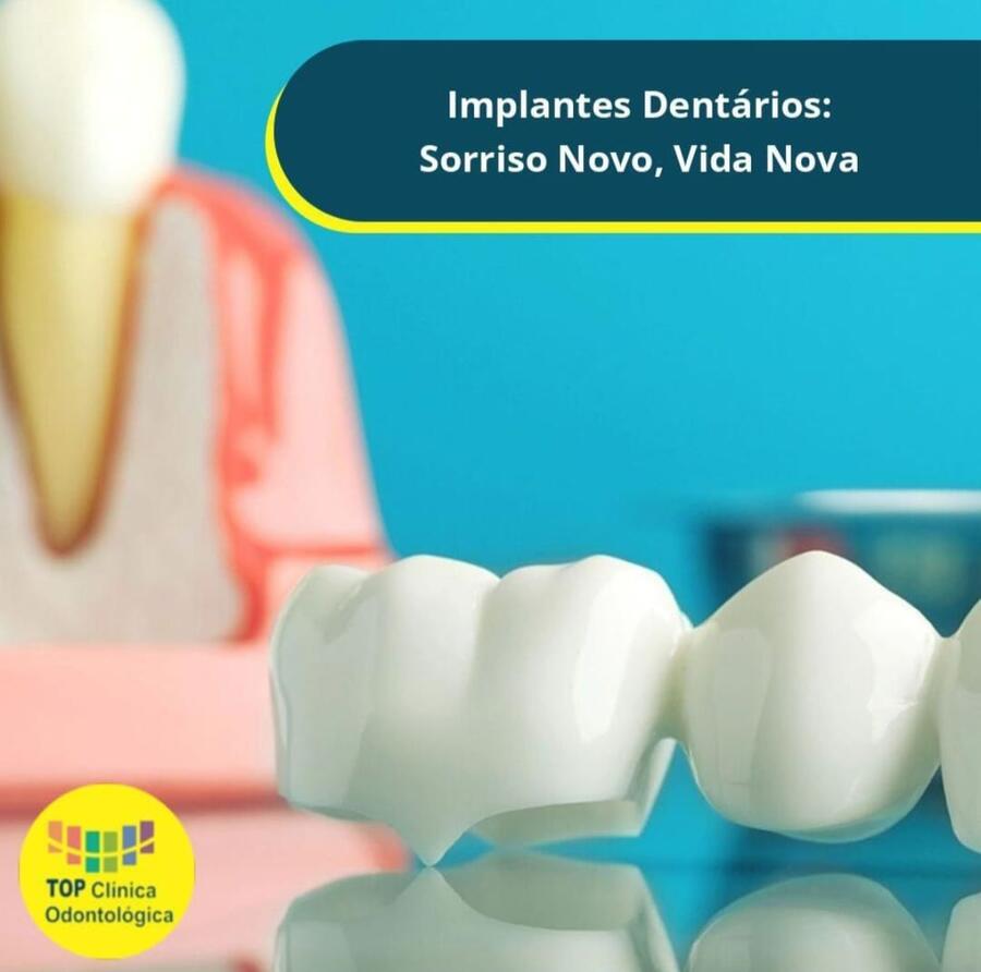 Implantes dentários